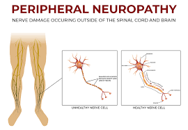neuropathy leg pain