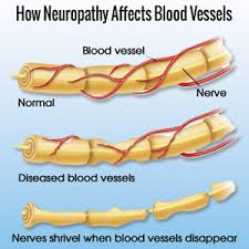 neuropathy affects blood vessels